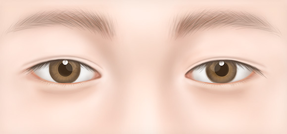 유형별 눈 재수술 | 시스템성형외과