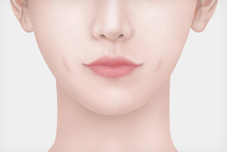 긴 보조개