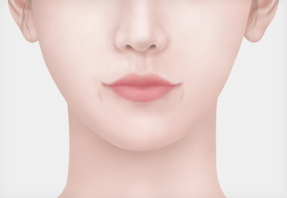 입꼬리 보조개