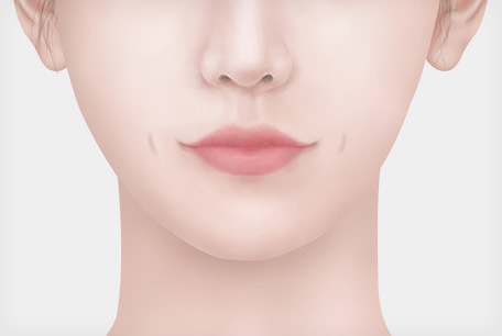 수술 볼 가운데 보조개
